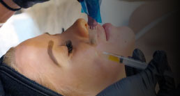 Vampire facial in Delhi - Facial fat removal and rejuvenation