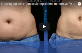 An Alternative to Liposuction