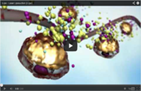 i-Lipo An Alternative to Liposuction